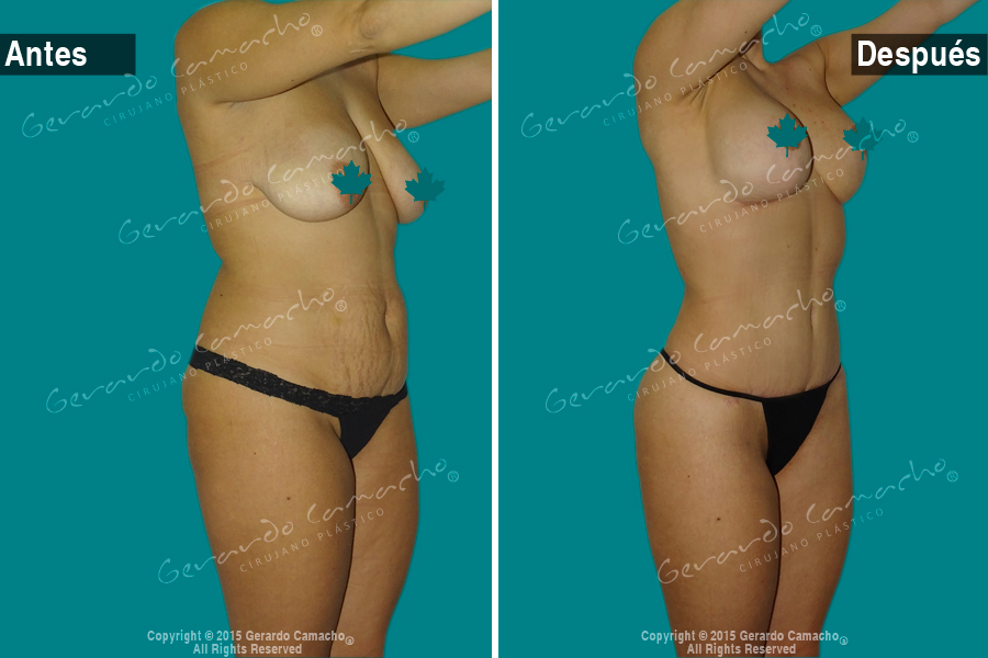  Mommy Makeover Gerardo Camacho